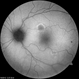 Multifocal Central Serous Chorioretinopathy Multifocal Central Serous Chorioretinopathy